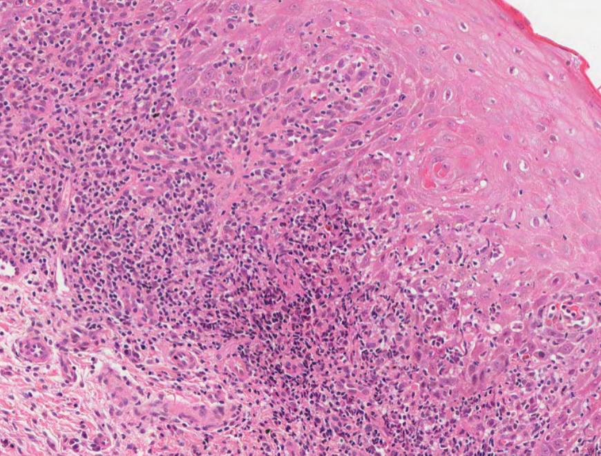 #caseoftheweek 🔬🔬🔬 Lovely example of a cause of a lacy white plaque on the oral mucosa. View the full slide here: virtualpathology.leeds.ac.uk/slides/library…  #pathX #PathTwitter