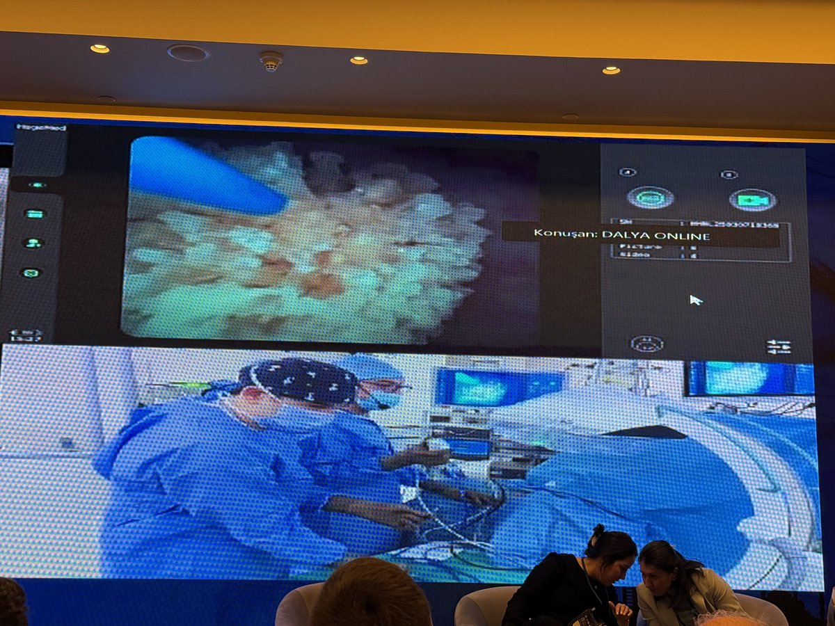 Guido Giusti (@guidogiusti) on Twitter photo In Istanbul today @ #IUD25 <a href="/sbinhamrii/">Saeed Bin Hamri</a> perfectly managing fluorlessly a pediatric #RIRS in a 6 yrs baby: suction sheath by <a href="/ClearpetraL/">ClearPetra-Well Lead</a> & small 6.5 scope by <a href="/ShenzhenHugeMed/">Shenzhen HugeMed</a> are key points! 👏🏻 In Istanbul today @ #IUD25 <a href="/sbinhamrii/">Saeed Bin Hamri</a> perfectly managing fluorlessly a pediatric #RIRS in a 6 yrs baby: suction sheath by <a href="/ClearpetraL/">ClearPetra-Well Lead</a> & small 6.5 scope by <a href="/ShenzhenHugeMed/">Shenzhen HugeMed</a> are key points! 👏🏻