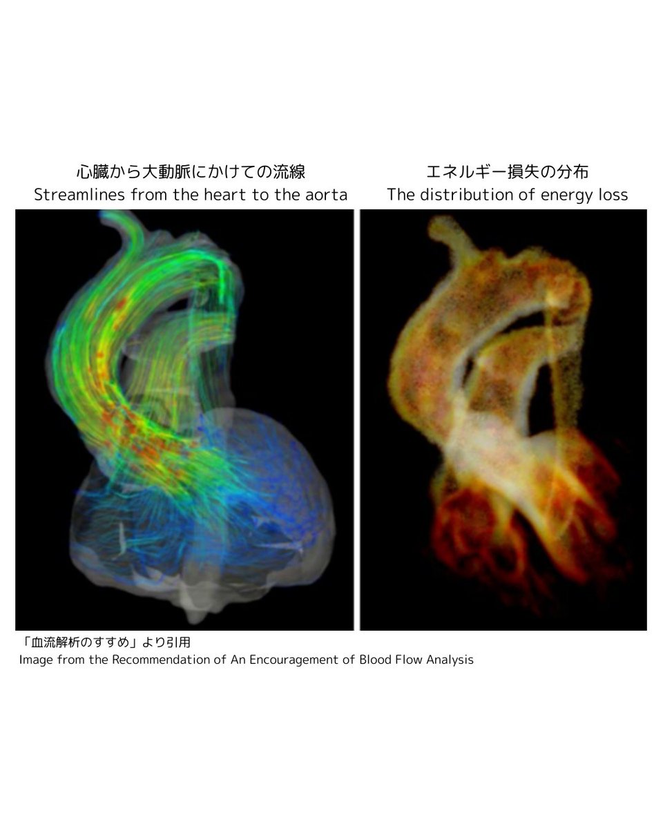 CFD_Inc's tweet photo. 画像は、MRIから得られた速度分布(左)と、そこから算出した粘性散逸エネルギー損失(右)を可視化したものです。
これらは、エネルギー損失(EL)を計算するのに大切な値です。
詳しい解説は「血流解析のすすめ」をご覧ください。
🫀https://t.co/1vzFaQMEUQ
#iTFlow #心負荷 #エネルギー損失 https://t.co/v6xXV5ecLs