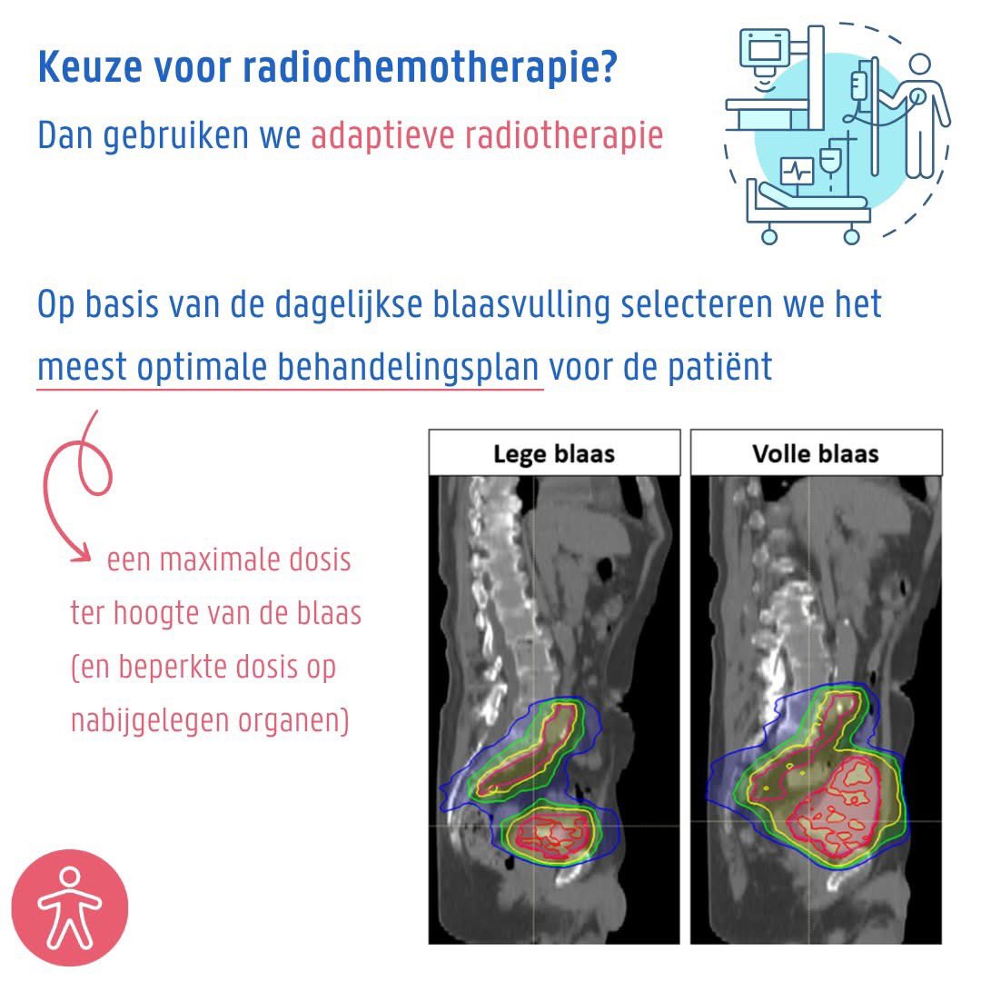 Valérie Fonteyne (@fontev1) on Twitter photo Honoured to had the opportunity to discuss the place of Adjuvant Radiotherapy for bladder Cancer and presenting the results of the Belgian trial supporting this approach!
Motivated to proceed with our ongoing EFFORT trial!
<a href="/FlorVerghote/">Flor Verghote</a> <a href="/camilleberquin/">Camille Berquin</a> <a href="/daandm/">De Maeseneer Daan</a> <a href="/uzgent/">UZ Gent</a> <a href="/ugent/">UGent</a> Honoured to had the opportunity to discuss the place of Adjuvant Radiotherapy for bladder Cancer and presenting the results of the Belgian trial supporting this approach!
Motivated to proceed with our ongoing EFFORT trial!
<a href="/FlorVerghote/">Flor Verghote</a> <a href="/camilleberquin/">Camille Berquin</a> <a href="/daandm/">De Maeseneer Daan</a> <a href="/uzgent/">UZ Gent</a> <a href="/ugent/">UGent</a>