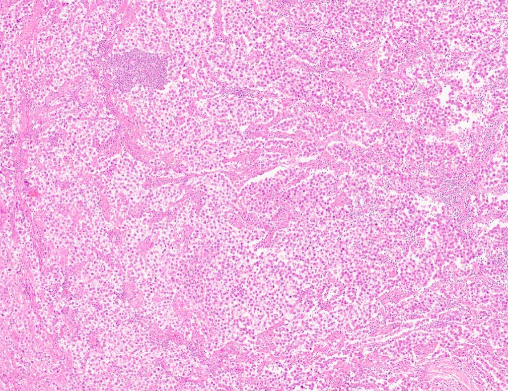 #caseoftheweek 🔬🔬🔬 What is causing a testicular lump in this patient with a raised LDH? View the full slide and thousands of others on the Leeds Virtual pathology website here:virtualpathology.leeds.ac.uk/slides/library… #pathX #PathTwitter #uropath