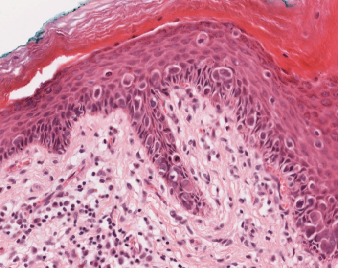 #caseoftheweek 🔬🔬🔬 What is causing this vulval lesion in this 57 year old woman? View the full slides on the Leeds Virtual pathology website here: virtualpathology.leeds.ac.uk/slides/library… #pathX #PathTwitter #gynaepath