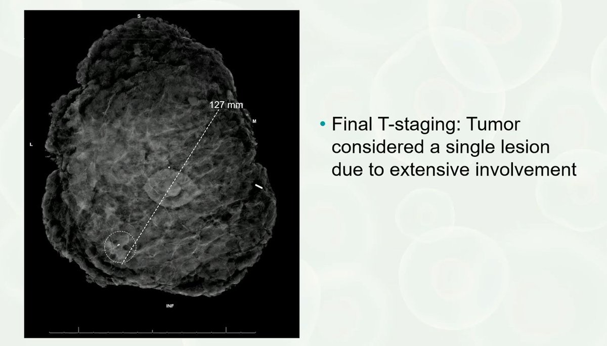 Challenges in staging Invasive Lobular Carcinoma (ILC)
Small mass detected on mammogram. Additional imaging showed architectural distorsion. Patient decided for mastectomy (pic 1)
Serial sections show two ill-defined noncontiguous lesions away from primary tumor (pic 2)