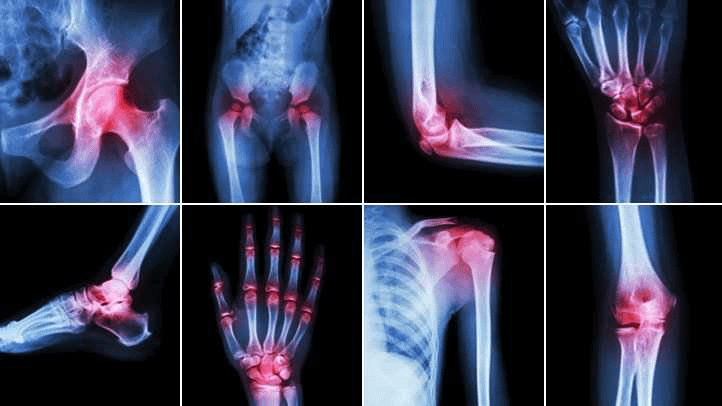 Every person over 35 blames aging for their stiff, aching joints.

Turns out it's not age... it's years of neglect catching up.

Here are 8 simple fixes to rebuild your joints and feel 25 again🧵: