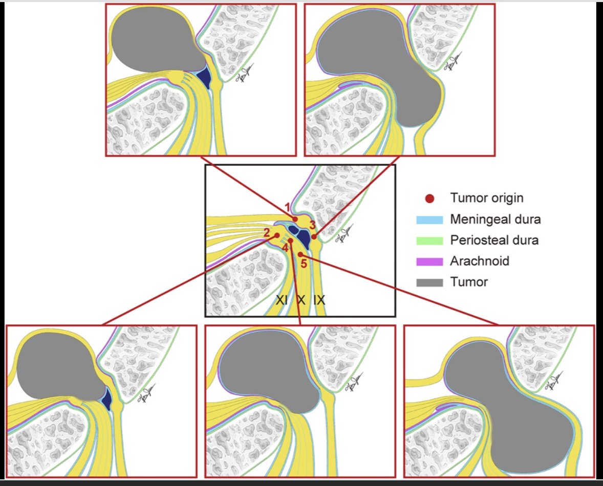 Neurosurgery Publications (@neurosurgerycns) on Twitter photo #ONSNew The Relationship Between Jugular Foramen Schwannoma and Surrounding Membrane Structures and Its Surgical Application bit.ly/43j9sp3 by Lin et al Southern Medical University, Guangzhou, Guangdong, China <a href="/IsaacYangMD/">Isaac Yang MD</a> <a href="/CNS_Update/">CNS</a> <a href="/DKondziolkaCNS/">Douglas Kondziolka</a> <a href="/george_maragkos/">George Maragkos, MD</a> #ONSNew The Relationship Between Jugular Foramen Schwannoma and Surrounding Membrane Structures and Its Surgical Application bit.ly/43j9sp3 by Lin et al Southern Medical University, Guangzhou, Guangdong, China <a href="/IsaacYangMD/">Isaac Yang MD</a> <a href="/CNS_Update/">CNS</a> <a href="/DKondziolkaCNS/">Douglas Kondziolka</a> <a href="/george_maragkos/">George Maragkos, MD</a>