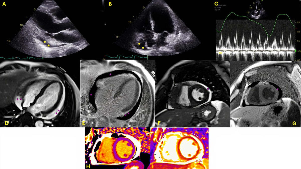 DeBakey CV Education - World Class CV Training (@debakeycvedu) on Twitter photo New #DeBakeyCVJournal MMI! A Blind Spot in Imaging: Immune Checkpoint Inhibitor-Induced #Myocarditis with Negative Cardiac MRI by <a href="/LubnaAlnatour/">Lubna Alnatour</a> Ayham Mahmoud <a href="/AmeerAwashra/">Ameer Awashra, MD</a> <a href="/PGYnoSleep/">Jonathan Na, MD</a> <a href="/ChamsiPash/">Mohammed Chamsi Pasha, FACC, FASE</a>
Video/images doi.org/10.14797/mdcvj…
<a href="/maquinonesmd/">M Quinones MD, MACC</a> <a href="/NadeenFaza/">Nadeen N. Faza, M.D.</a> @HMHcardiofellow New #DeBakeyCVJournal MMI! A Blind Spot in Imaging: Immune Checkpoint Inhibitor-Induced #Myocarditis with Negative Cardiac MRI by <a href="/LubnaAlnatour/">Lubna Alnatour</a> Ayham Mahmoud <a href="/AmeerAwashra/">Ameer Awashra, MD</a> <a href="/PGYnoSleep/">Jonathan Na, MD</a> <a href="/ChamsiPash/">Mohammed Chamsi Pasha, FACC, FASE</a>
Video/images doi.org/10.14797/mdcvj…
<a href="/maquinonesmd/">M Quinones MD, MACC</a> <a href="/NadeenFaza/">Nadeen N. Faza, M.D.</a> @HMHcardiofellow