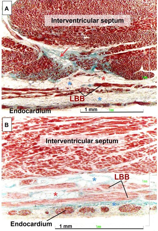 Dr. José Ángel Cabrera (@jacabreracardio) on Twitter photo Dear colleagues and friends,
We are pleased to share with you our recent work. <a href="/JACCJournals/">JACC Journals</a> #JACCEP
“Left Bundle Branch Pacing: Histology, the Key to Understand Different Responses”
kwnsfk27.r.eu-west-1.awstrack.me/L0/https:%2F%2…
“A picture is worth a thousand words.”👇 Dear colleagues and friends,
We are pleased to share with you our recent work. <a href="/JACCJournals/">JACC Journals</a> #JACCEP
“Left Bundle Branch Pacing: Histology, the Key to Understand Different Responses”
kwnsfk27.r.eu-west-1.awstrack.me/L0/https:%2F%2…
“A picture is worth a thousand words.”👇