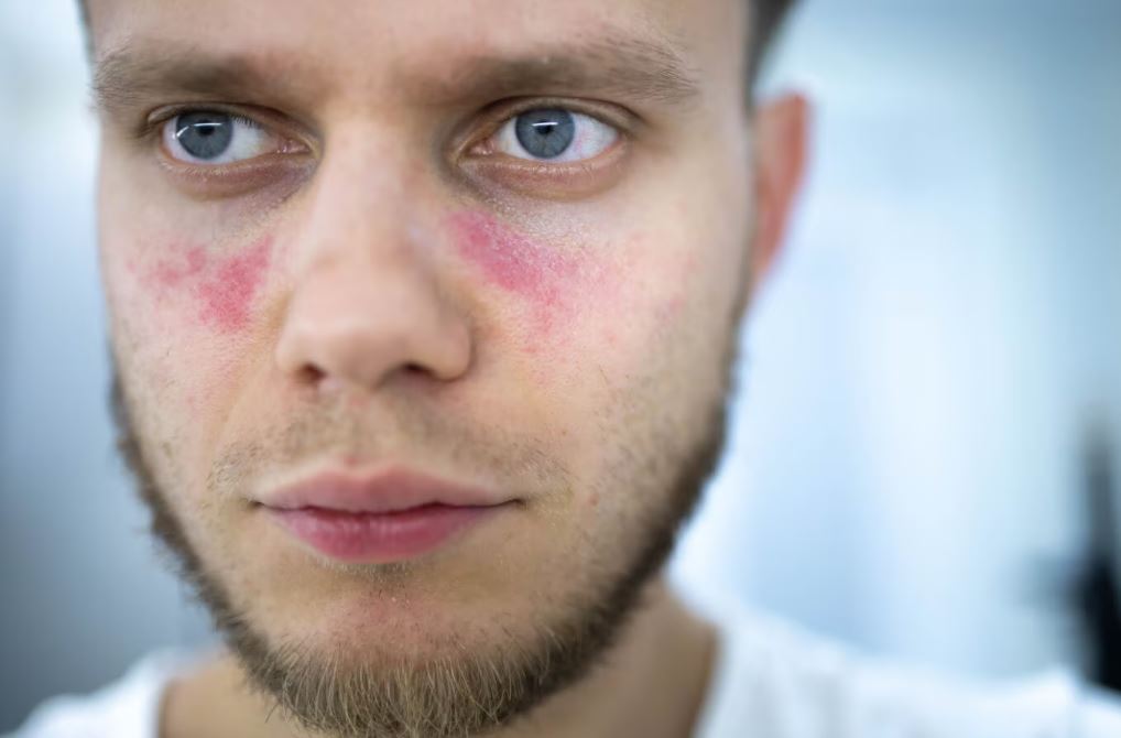Did you know Lupus can affect your eyes? Symptoms like dry eye, inflammation and vision changes are common. Learn how #Lupus can affect your vision and what to watch for: allaboutvision.com/conditions/lup… #LupusAwareness #EyeHealth