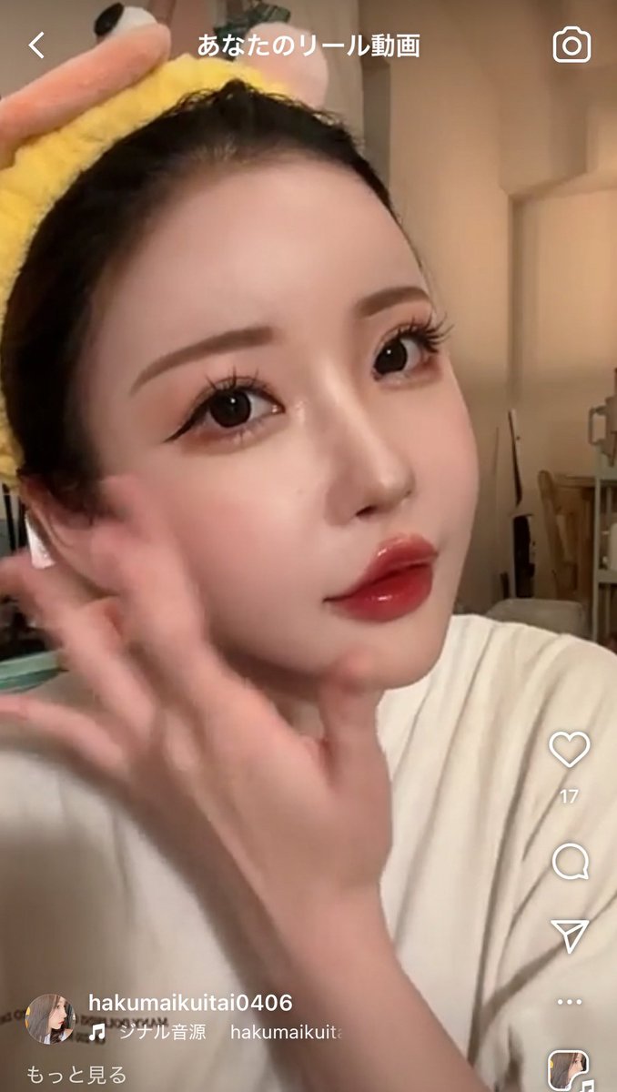 4年でめっちゃ顔変わった。

目の整形と唇は多分もう終わりで
フェイスラインと鼻はあと少し。

目は、額挙上とタレ目、眼窩脂肪移植してかなり大きくなってフェイスラインは糸と脂肪で整えて、額は毛髪移植3000毛した。

これ見ると結構出目になってる。