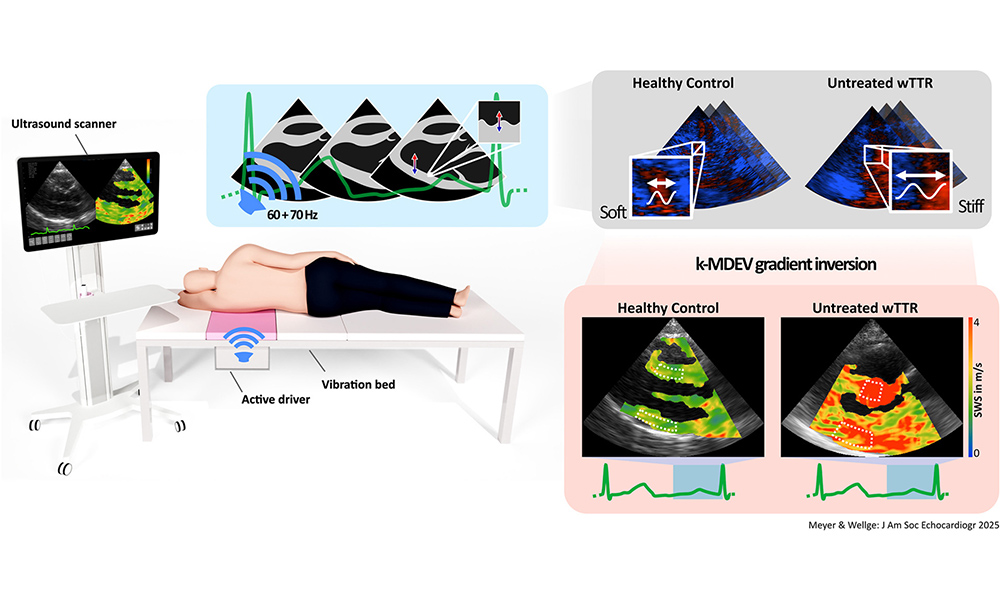 Approximately 50% of patients with heart failure have heart failure with preserved ejection fraction and concomitant diastolic dysfunction, in part caused by increased myocardial stiffness not detectable by standard echo.

Read our <a href="/JournalASEcho/">JASE</a> report: bit.ly/3GNNPob
