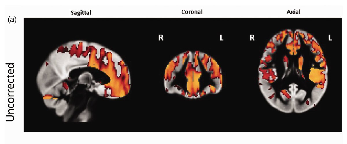 🚨#HotTopic from the Chinese PREVENT cohort: Young MAPT rs242557 A carriers show regional hyperperfusion in the brain - even before #cognitive symptoms arise. No APOE effects observed.

🧠 Could this be an early marker of #Alzheimer’s risk?

Full story 👉journals.sagepub.com/doi/full/10.11…