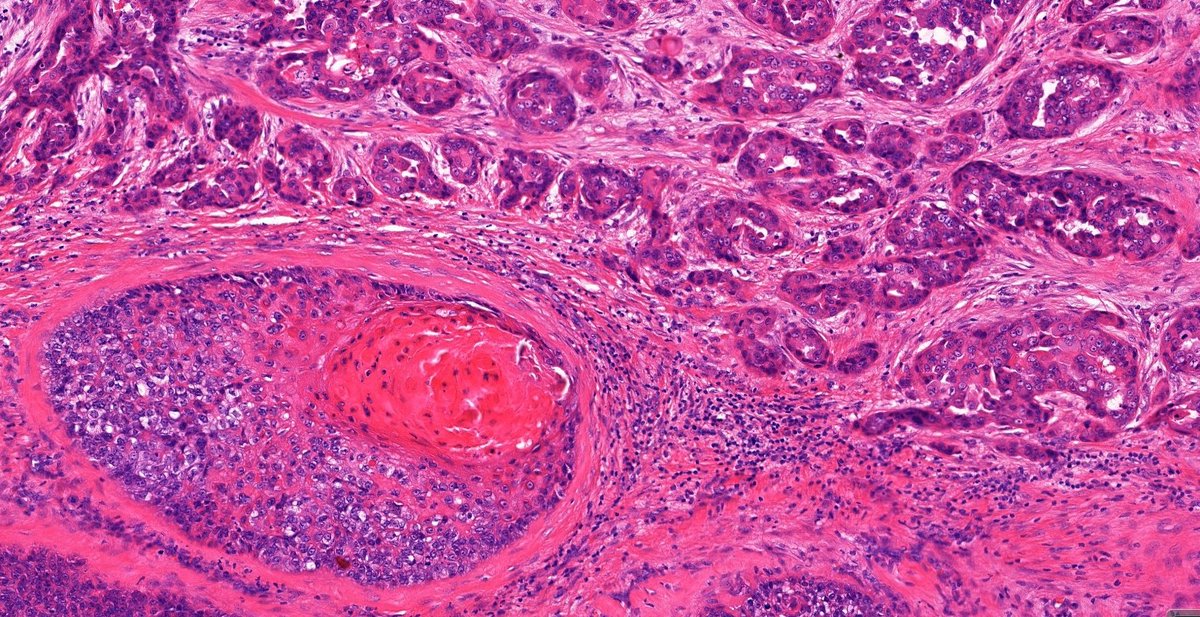 Annamária Ribiánszky, MD (@ribianszkya) on Twitter photo 48 yo M with a 10-year history of occipital subcutaneous mass, presumed lipoma, resected surgically.
I’d appreciate your opinion!
<a href="/HENRYY_MD/">Henry YANG</a>
<a href="/MarcelaSaebL/">Marcelasaeblima.</a>
<a href="/DanGrahamMD/">Dan Graham</a> <a href="/MirunaPopescu13/">Miruna Popescu, MD</a> <a href="/_Wondweson64/">Wondweson64 Alemu</a>
<a href="/DrGeeONE/">Olaleke Folaranmi</a>
<a href="/MAHoureih/">M Adib Houreih, M.D, DipRCPath محمد أديب حورية</a>
#Dermpath #PathTwitter 48 yo M with a 10-year history of occipital subcutaneous mass, presumed lipoma, resected surgically.
I’d appreciate your opinion!
<a href="/HENRYY_MD/">Henry YANG</a>
<a href="/MarcelaSaebL/">Marcelasaeblima.</a>
<a href="/DanGrahamMD/">Dan Graham</a> <a href="/MirunaPopescu13/">Miruna Popescu, MD</a> <a href="/_Wondweson64/">Wondweson64 Alemu</a>
<a href="/DrGeeONE/">Olaleke Folaranmi</a>
<a href="/MAHoureih/">M Adib Houreih, M.D, DipRCPath محمد أديب حورية</a>
#Dermpath #PathTwitter