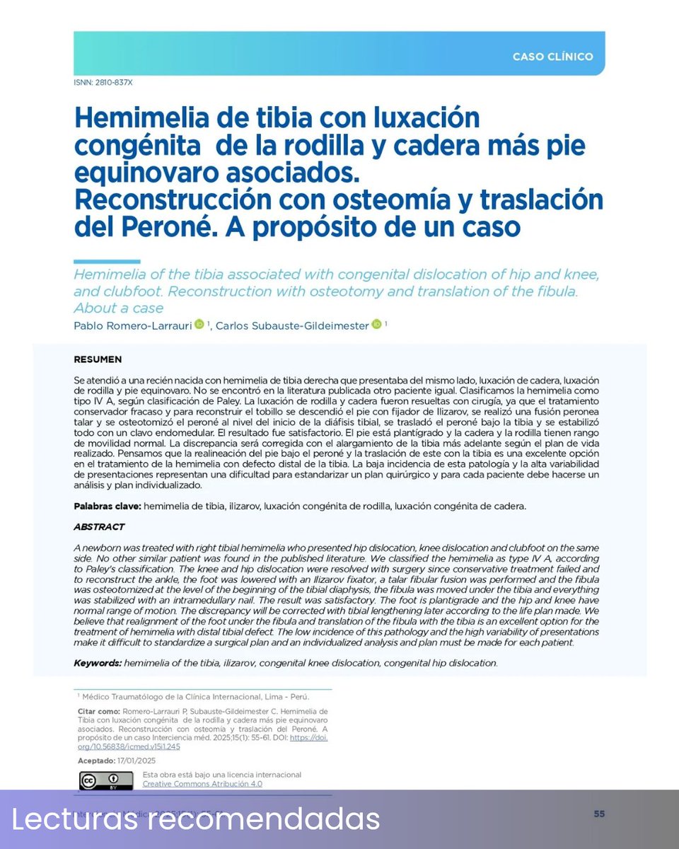 🦵 interesante técnica para reconstrucción en hemimelia de tibia con defectos asociados (luxaciones, pie equinovaro). Osteotomía y traslación de peroné presentada por Romero-Larrauri &amp; Subauste-Gildeimester en Interciencia Médica (¡Open Access! 🔓).
&gt; ➡️ doi.org/10.56838/icmed…