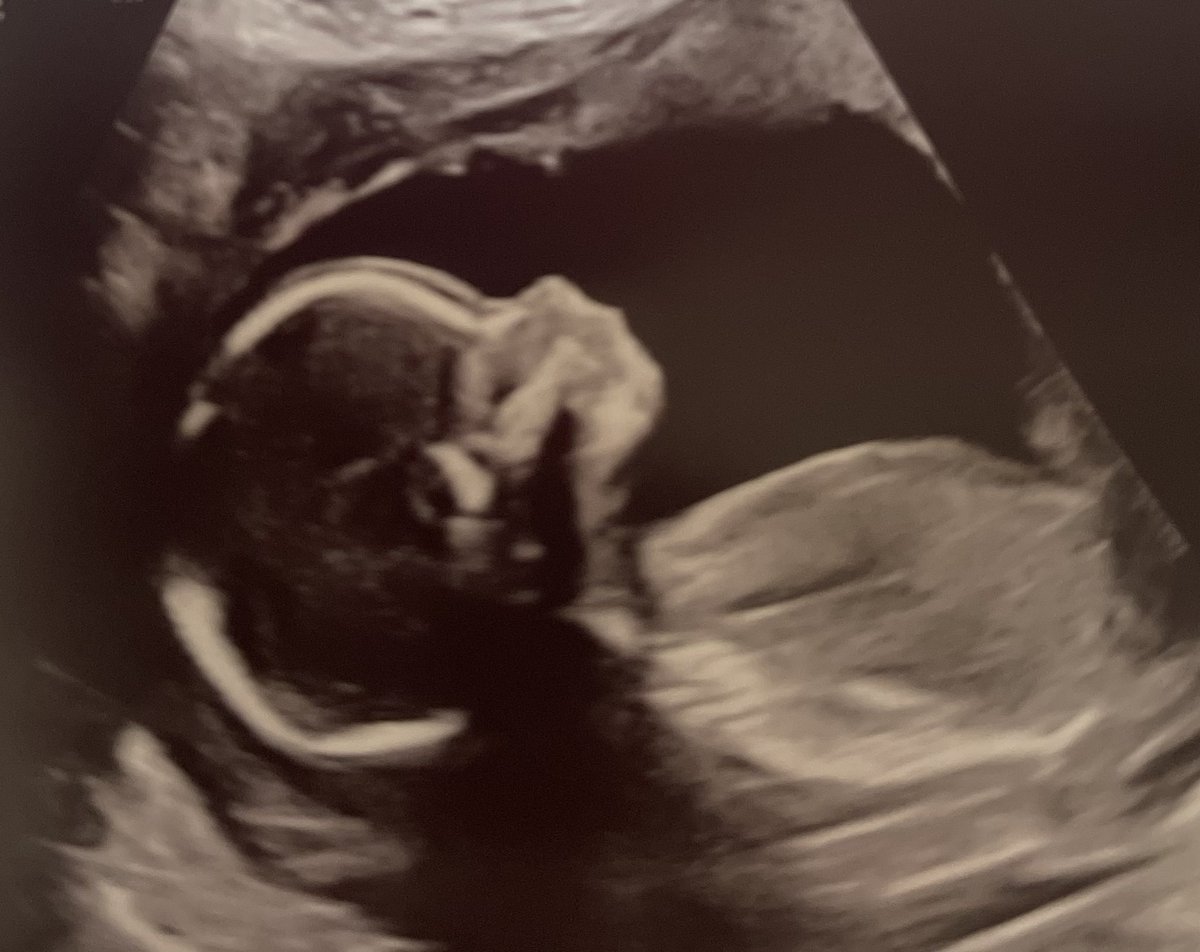 🎀 We are having a GIRL 🎀

- the pic of the little feet we will be chasing around 🥹