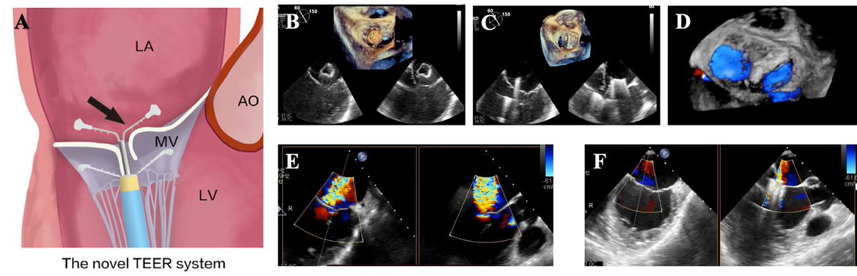 Journal of Invasive Cardiology (@invasivecardiol) on Twitter photo 📖 Read the May issue now! hubs.ly/Q03lq-rC0
<a href="/dnzmtlu/">Deniz Mutlu</a> <a href="/CCAD_MHIF/">Center for Coronary Artery Disease</a> <a href="/LAzzaliniMD/">Lorenzo Azzalini</a> <a href="/yadersandoval/">Yader Sandoval</a> <a href="/esbrilakis/">Emmanouil Brilakis</a> <a href="/AaronLeeMD/">Aaron Lee</a> <a href="/OpolskiMP/">Maksymilian Opolski</a> <a href="/VCUHealthHeart/">VCU Health Pauley Heart Center</a> @craigbasman <a href="/RimmyGarg/">Rimmy Garg, MD</a>
<a href="/DLBHATTMD/">Dr. Deepak L. Bhatt</a> #cardioTwitter #cardioX #cardiology #interventionalcardiology 📖 Read the May issue now! hubs.ly/Q03lq-rC0
<a href="/dnzmtlu/">Deniz Mutlu</a> <a href="/CCAD_MHIF/">Center for Coronary Artery Disease</a> <a href="/LAzzaliniMD/">Lorenzo Azzalini</a> <a href="/yadersandoval/">Yader Sandoval</a> <a href="/esbrilakis/">Emmanouil Brilakis</a> <a href="/AaronLeeMD/">Aaron Lee</a> <a href="/OpolskiMP/">Maksymilian Opolski</a> <a href="/VCUHealthHeart/">VCU Health Pauley Heart Center</a> @craigbasman <a href="/RimmyGarg/">Rimmy Garg, MD</a>
<a href="/DLBHATTMD/">Dr. Deepak L. Bhatt</a> #cardioTwitter #cardioX #cardiology #interventionalcardiology
