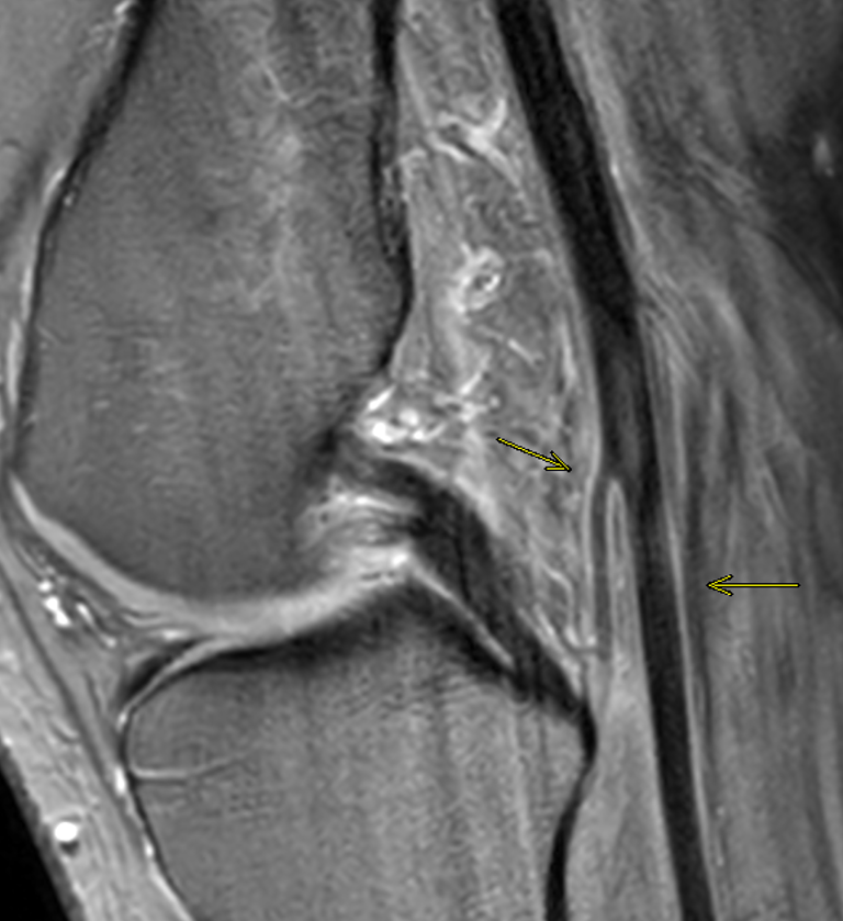 What anatomical variant is shown here? 
Why is it relevant? 🤔📚

<a href="/SidThakerMSK/">Siddharth Thaker (Thee/Thou/Thine)</a> <a href="/jacja_/">JJ</a>