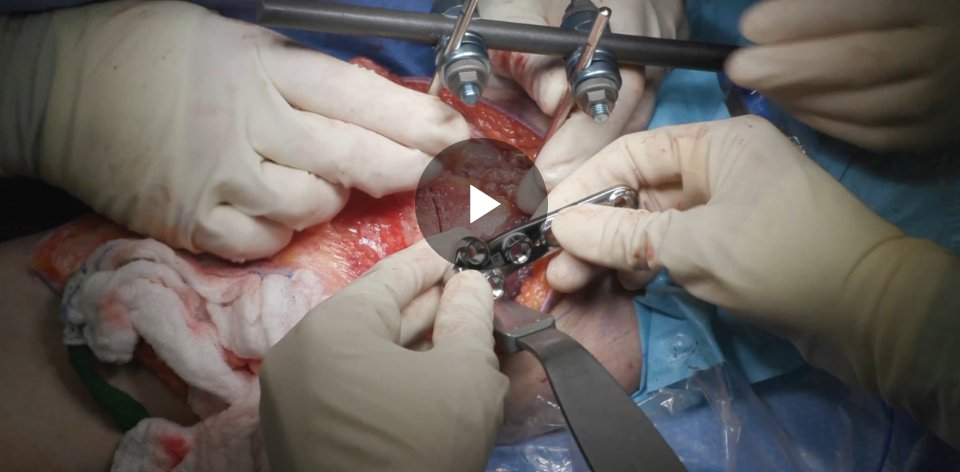 AAOS (@aaos1) on Twitter photo Celebrating the #AAOS2025 #OVT Award Winners! Derotational Medial Closing Wedge DFO, TTO, and #MQTFL Reconstruction for Recurrent #Patellar Instability bit.ly/3Rl8AcH
Submit YOUR #AAOS2026 video thru July 15
@dylanlowemd
<a href="/nyulangone/">NYU Langone Health</a>
<a href="/nyulangoneortho/">NYU Langone Orthopedics</a>
#OVTFridays
#CME Celebrating the #AAOS2025 #OVT Award Winners! Derotational Medial Closing Wedge DFO, TTO, and #MQTFL Reconstruction for Recurrent #Patellar Instability bit.ly/3Rl8AcH
Submit YOUR #AAOS2026 video thru July 15
@dylanlowemd
<a href="/nyulangone/">NYU Langone Health</a>
<a href="/nyulangoneortho/">NYU Langone Orthopedics</a>
#OVTFridays
#CME