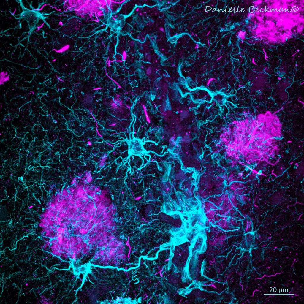 Astrocytes🔵 reacting to B-amyloid🟣 accumulation in the Human Neocortex. One of the hallmarks of #Alzheimers and other neurodegenerative conditions. What if viral infections increase the accumulation of these and other misfolded proteins in the brain? 🤔🔬#FluorescenceFriday