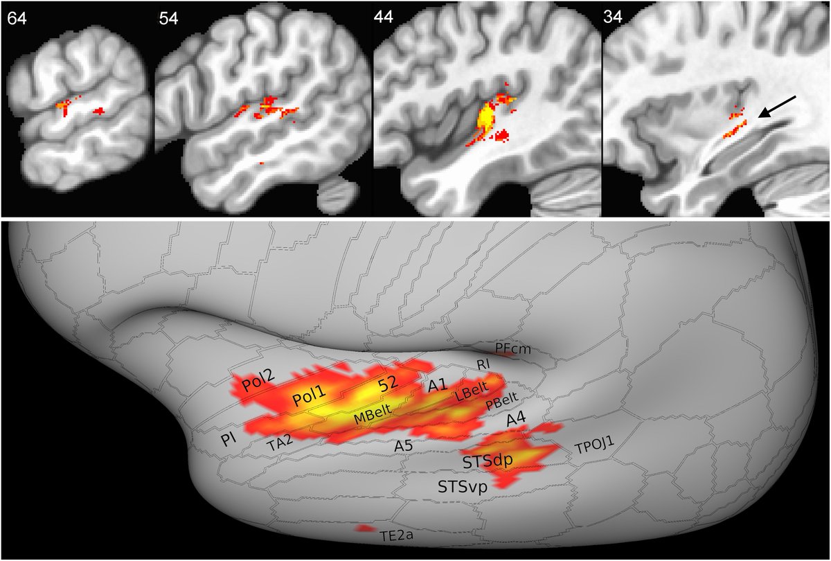 Binder et al. explore impairments in acoustic-phonetic perception in a large cohort of patients with chronic left hemisphere stroke to determine how unilateral damage can affect specific aspects of low-level speech processing. tinyurl.com/yum6y7b6; tinyurl.com/bdejez6e