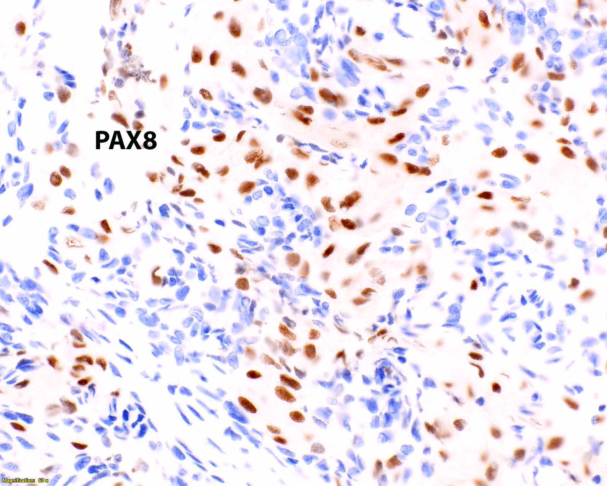 Elizabeth Montgomery, MD (@lizmontgomerymd) on Twitter photo Metastatic renal cell carcinoma is really a sneaky thing. This example produced a duodenal submucosal lesion - at first glance it resembles Brunner glands. #UMiamiPath <a href="/ModernPathology/">Modern Pathology</a> <a href="/science_press/">Innovative Science Press</a> Metastatic renal cell carcinoma is really a sneaky thing. This example produced a duodenal submucosal lesion - at first glance it resembles Brunner glands. #UMiamiPath <a href="/ModernPathology/">Modern Pathology</a> <a href="/science_press/">Innovative Science Press</a>