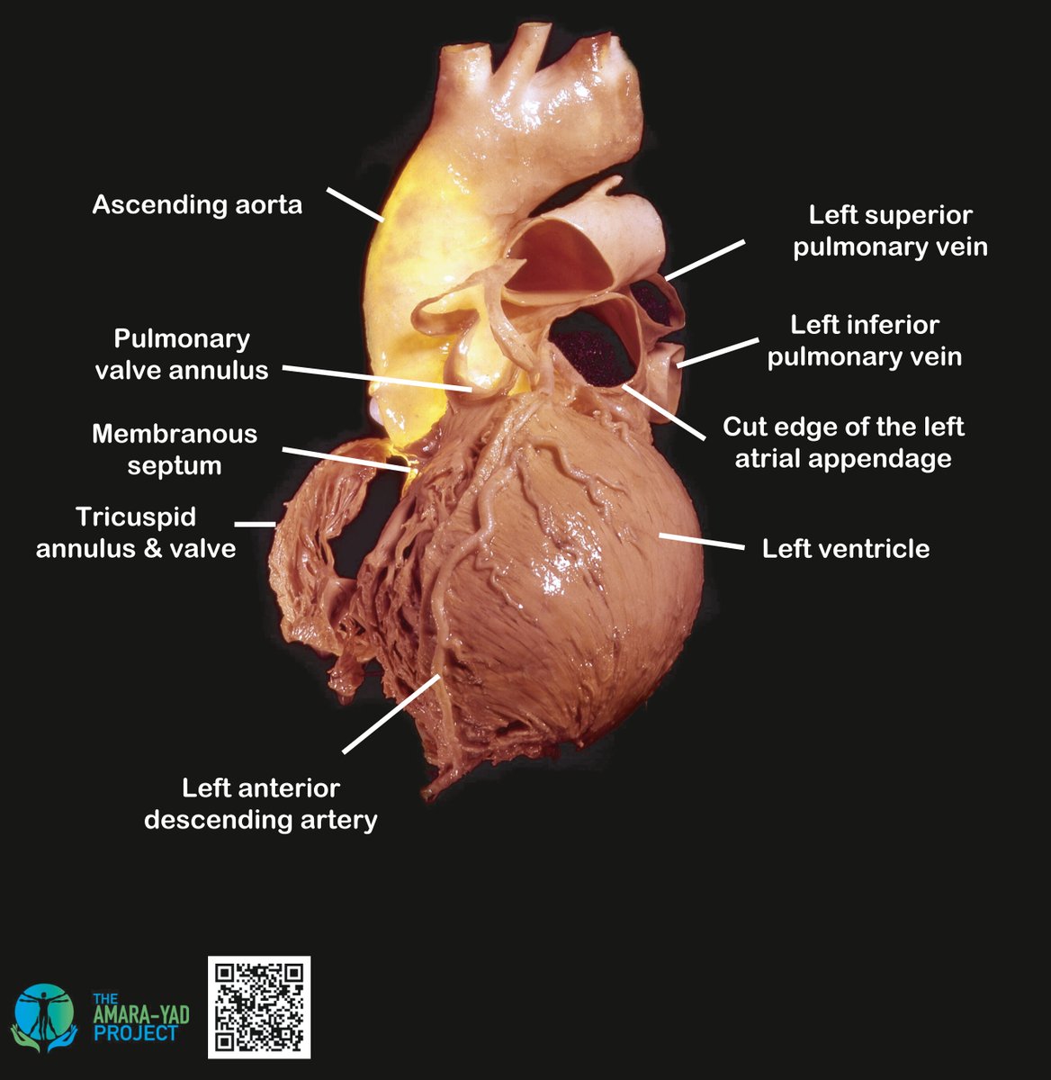 JACC Journals (@jaccjournals) on Twitter photo Cardiac anatomy, but make it *art* 🎨 This week’s Amara Yad Image captures the aorta-pulmonary valve relationship like never before. A must-see in #JACC: jacc.org/doi/10.1016/j.… <a href="/shivkumarmd/">Kalyanam Shivkumar MD PhD</a> Cardiac anatomy, but make it *art* 🎨 This week’s Amara Yad Image captures the aorta-pulmonary valve relationship like never before. A must-see in #JACC: jacc.org/doi/10.1016/j.… <a href="/shivkumarmd/">Kalyanam Shivkumar MD PhD</a>