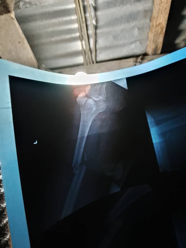 mrsoundflow's tweet image. I was booked for surgery but need 1.3M to pay for it @DONJAZZY @asher_kine @romeocza @BETFUSE1 I need your help to walk again