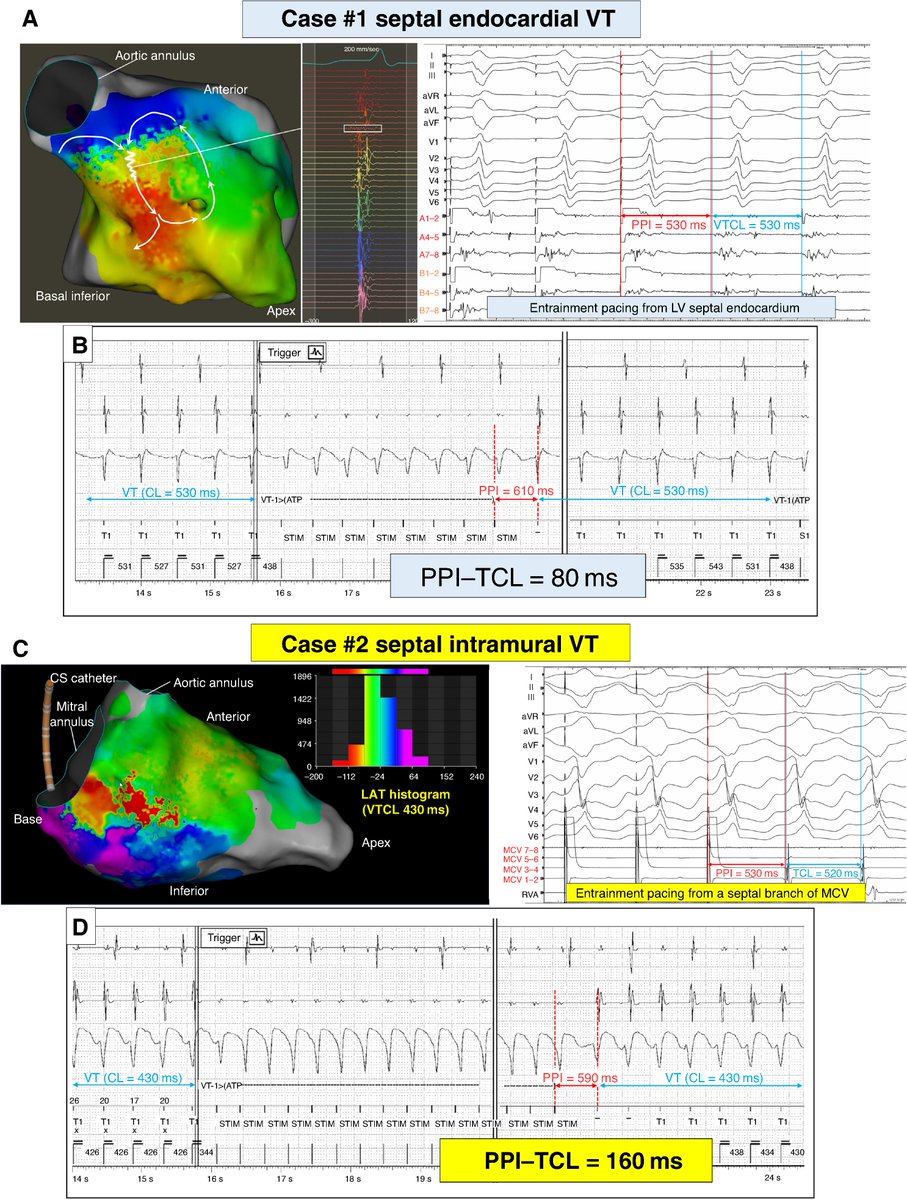 Pasquale Santangeli (@dr_santangeli) on Twitter photo Post-pacing interval after failed anti-tachycardia pacing for scar-related ventricular tachycardia: implications for the location of the critical substrate <a href="/EuropaceEiC/">Europace Editor-in-Chief</a> <a href="/CleClinicHVTI/">Cleveland Clinic Heart, Vascular & Thoracic</a> <a href="/KojiHiguchiCCF/">Koji Higuchi, MD, PhD</a> academic.oup.com/europace/artic… Post-pacing interval after failed anti-tachycardia pacing for scar-related ventricular tachycardia: implications for the location of the critical substrate <a href="/EuropaceEiC/">Europace Editor-in-Chief</a> <a href="/CleClinicHVTI/">Cleveland Clinic Heart, Vascular & Thoracic</a> <a href="/KojiHiguchiCCF/">Koji Higuchi, MD, PhD</a> academic.oup.com/europace/artic…