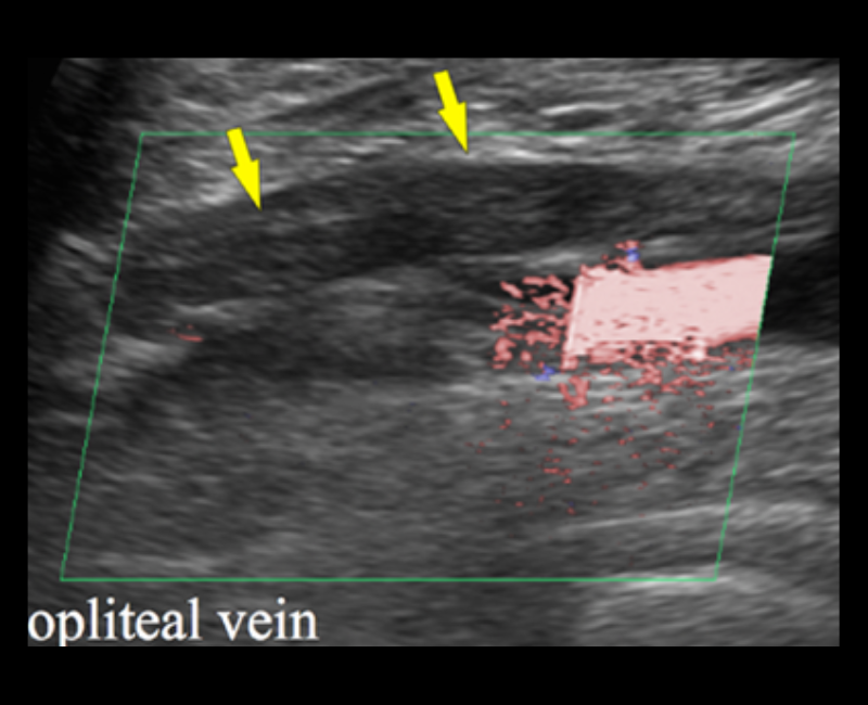 ASA (@asasonography) on Twitter photo đ This Sonography case presents a rare co-occurrence of DVT and Baker's cyst identified on ultrasound. #SupportingSonographers <a href="/WileyHealth/">Wiley Clinical Health</a>
loom.ly/I03OEcc đ This Sonography case presents a rare co-occurrence of DVT and Baker's cyst identified on ultrasound. #SupportingSonographers <a href="/WileyHealth/">Wiley Clinical Health</a>
loom.ly/I03OEcc