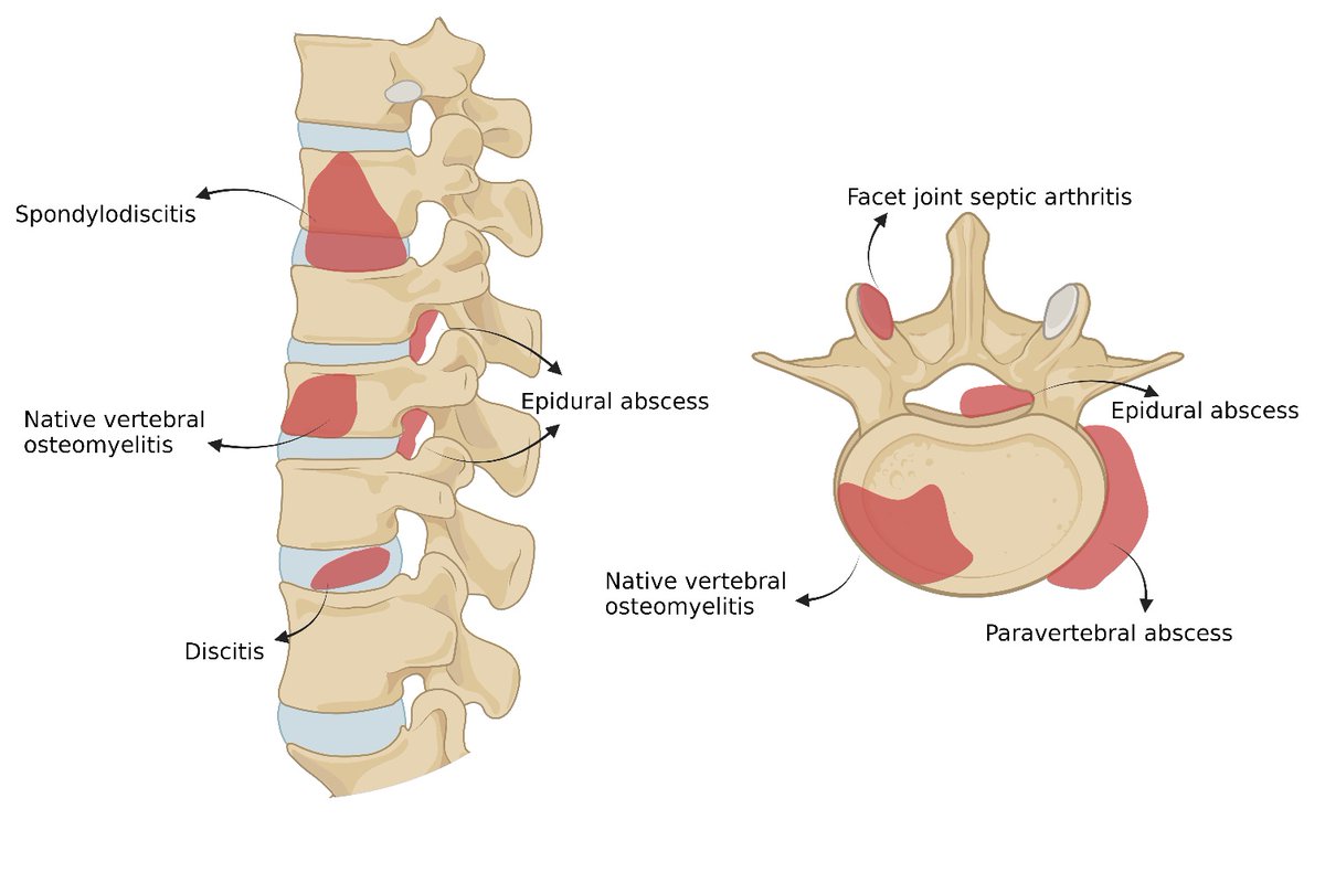 MedEd_Cases's tweet photo. This was a 24 year old male presenting with back pain and fever…
Watch: https://t.co/VCoGTQRo01
Read: https://t.co/R5IkdpkVZA
#MedEd #MedicalEducation #Medicine #MedSchool #MedStudent #physicianassistant #nurse #doctor #nursepractitioner #paschool #medicalschool #palife #physicianassistantlife #nursing #EmergencyMedicine #Neurosurgery #InfectiousDisease