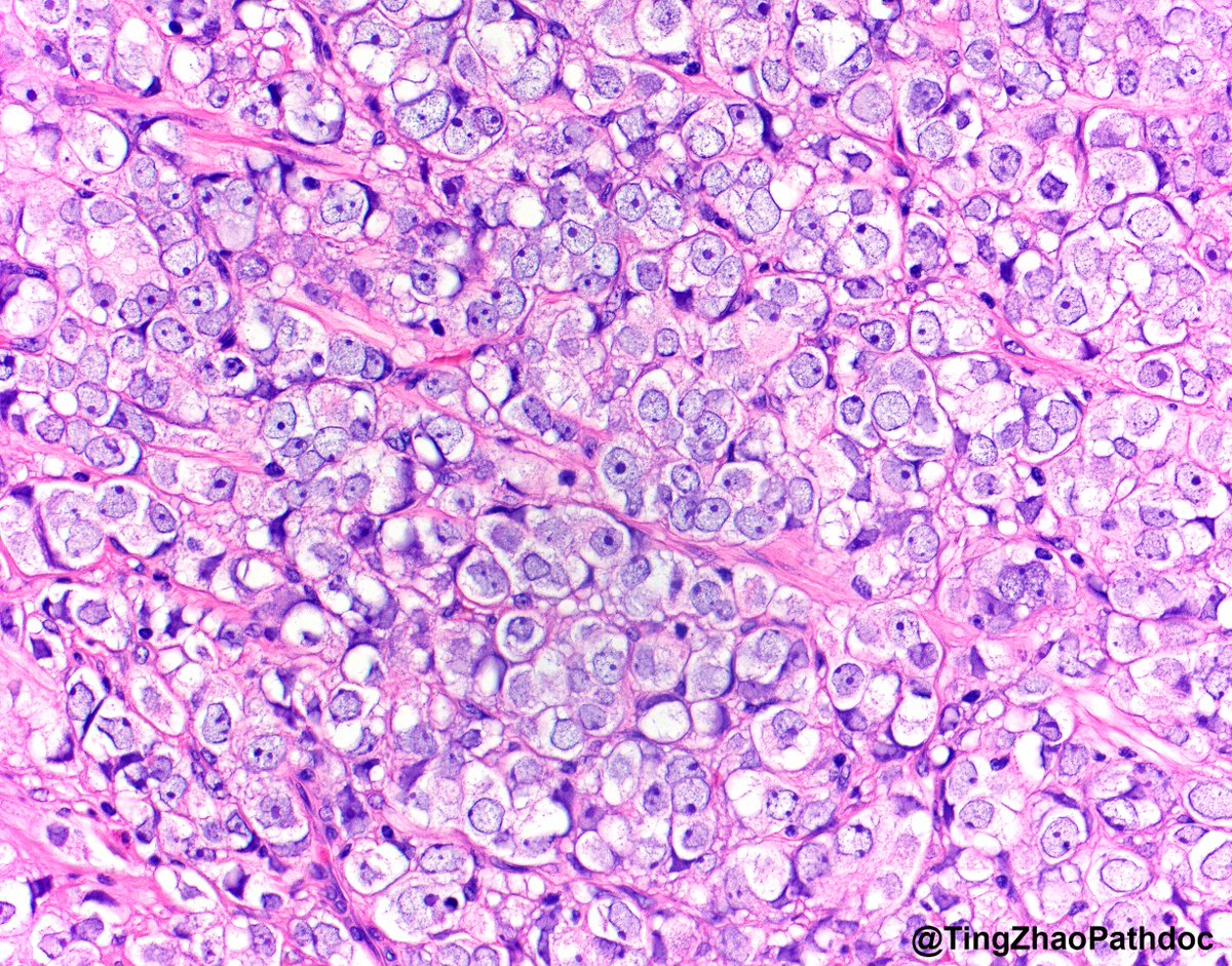 80 y.o. M, h/o basal cell carcinoma (no other cancer hx), presented with a lesion in the bladder trigone. What is your diagnosis on the transurethral resection specimen? 

#PathTwitter
<a href="/MGBpathology/">Mass General Brigham Pathology</a> <a href="/MGHPathology/">MGH Pathology</a>