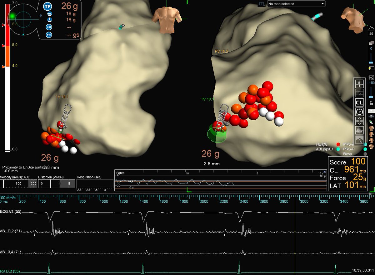 Subcutaneous ICD and catheter ablation in patient with arrythmogenic cardiomyopathy and sustained VT: a valid approach to avoid transvenous ICD
University of Padova, Italy