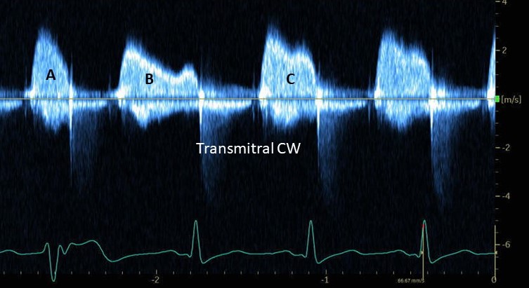 A patient with dyspnea. Mitral opening is restricted. Transmitral CW Doppler is obtained.