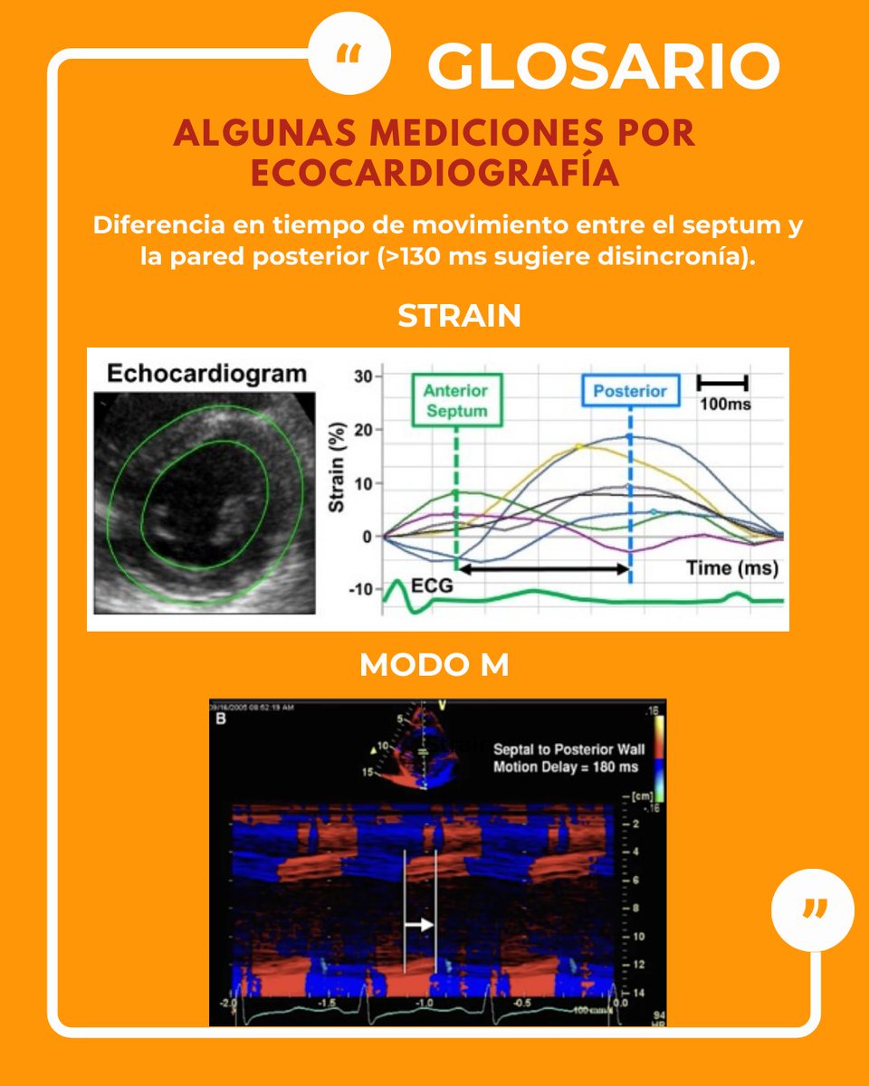 Disincronía ventricular: Descoordinación en la activación y contracción de las paredes ventriculares.