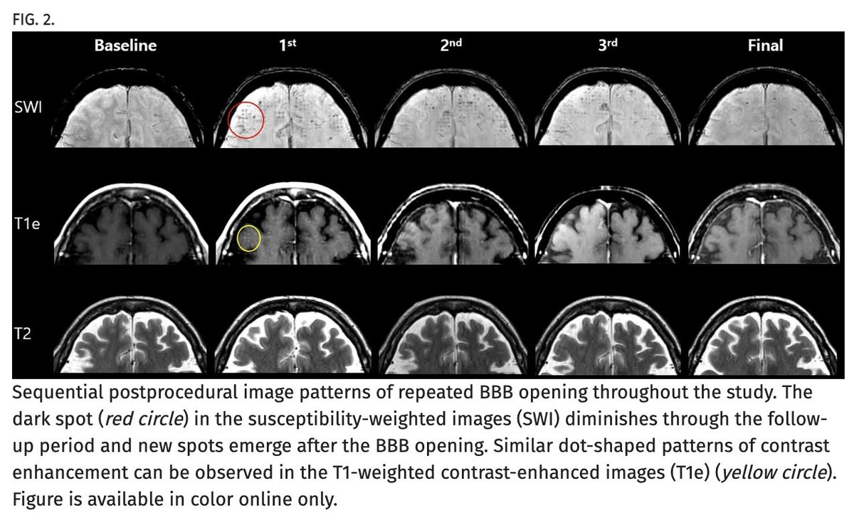 A recent <a href="/TheJNS/">Journal of Neurosurgery</a> study indicated neuropsychiatric improvement following use of focused ultrasound to
open the blood-brain barrier in Alzheimer’s disease.

<a href="/AANSNeuro/">AANS</a> <a href="/CNS_Update/">CNS</a> 
#neurosurgery #FUS #Alzheimers #MedTwitter #MedX

thejns.org/view/journals/…
