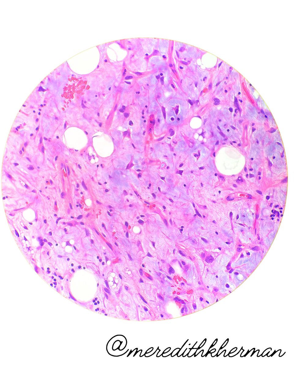 Meredith Herman, DO (@meredithkherman) on Twitter photo I Spy 🔍
🔬Thigh mass
🔬Lipoblasts
🔬Bland stellate cells
🔬Myxoid stroma
🔬Delicate arborizing capillaries
Did you solve the case? Answer below 👇
#PathQuiz #Pathology #PathX #BSTPath <a href="/KyleDPerryMD/">Kyle Perry</a> <a href="/UMichPath/">Michigan Pathology</a> I Spy 🔍
🔬Thigh mass
🔬Lipoblasts
🔬Bland stellate cells
🔬Myxoid stroma
🔬Delicate arborizing capillaries
Did you solve the case? Answer below 👇
#PathQuiz #Pathology #PathX #BSTPath <a href="/KyleDPerryMD/">Kyle Perry</a> <a href="/UMichPath/">Michigan Pathology</a>