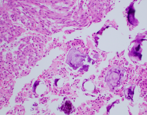 LAPF Patología (@latinamericanpf) on Twitter photo El tumor de Sertoli calcificante de células grandes es un tumor del estroma de los cordones sexuales extremadamente raro que se presenta esporádicamente o en el contexto del complejo de Carney. La mayoría de los casos son benignos, pero puede ser maligno.
Autor: <a href="/NMShillingford/">Nick Shillingford</a> El tumor de Sertoli calcificante de células grandes es un tumor del estroma de los cordones sexuales extremadamente raro que se presenta esporádicamente o en el contexto del complejo de Carney. La mayoría de los casos son benignos, pero puede ser maligno.
Autor: <a href="/NMShillingford/">Nick Shillingford</a>