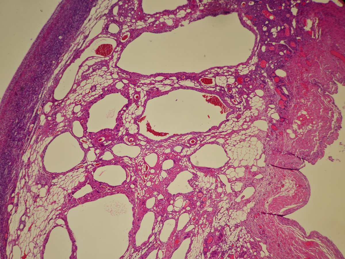 Interesting pattern of extensive fat necrosis in a mature ovarian teratoma with only focal ectodermal and endodermal elements (latter not shown). The whole tumor looked like this, with extensive foreign body cell reaction and histiocytic inflammation.

#PathTwitter #gynpath