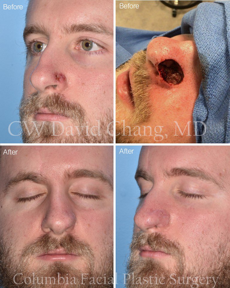 Skin cancer can be a devastating diagnosis—especially when it affects the face. 
I'm proud of this young man for his resilience as he underwent a multi-stage #ForeheadFlap reconstruction to restore his nasal defect. His determination has been inspiring.

#ENTSurgery #NasalRecon