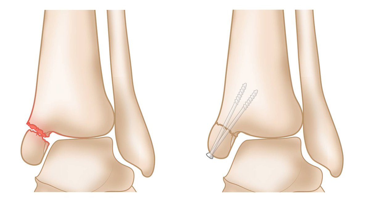 Dua na sala zenu. Jana nimeanza safari ya siku 30 ya matibabu ya mfupa uliovunjika kitaalamu unaitwa "Right Medial malleolar Fracture", kwa kufungwa POP. Awali madaktari walitaka kunifunga nati kama inavyoonekana kwenye picha ya tatu hapo. Lakini nikashauriana nao wakasema POP