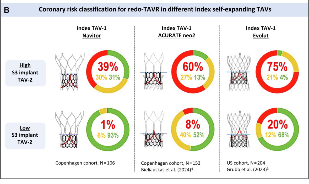 Arif Khokhar (@drarifk) on Twitter photo Redo-TAVR for tall-frame valves:
(Navitor, Acurate, Evolut)
Real-world CT analysis led by <a href="/yusuke_kobari/">Yusuke Kobari</a>
Coronary Risk affected by:
🎯1st valve design
🎯 1st valve depth
🎯 2nd valve depth
Article 👇
<a href="/JACCJournals/">JACC Journals</a>
sciencedirect.com/science/articl… Redo-TAVR for tall-frame valves:
(Navitor, Acurate, Evolut)
Real-world CT analysis led by <a href="/yusuke_kobari/">Yusuke Kobari</a>
Coronary Risk affected by:
🎯1st valve design
🎯 1st valve depth
🎯 2nd valve depth
Article 👇
<a href="/JACCJournals/">JACC Journals</a>
sciencedirect.com/science/articl…