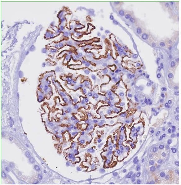 DrAhmedKalebi's tweet image. Picture perfect glomerulus done IHC immunohistochemical stain in a renal biopsy of a patient nephrotic range proteinuria 🤩 The blessed beauty of diagnostic nephropathology  #RenalPath #NephroPath #Renal #Nephrology