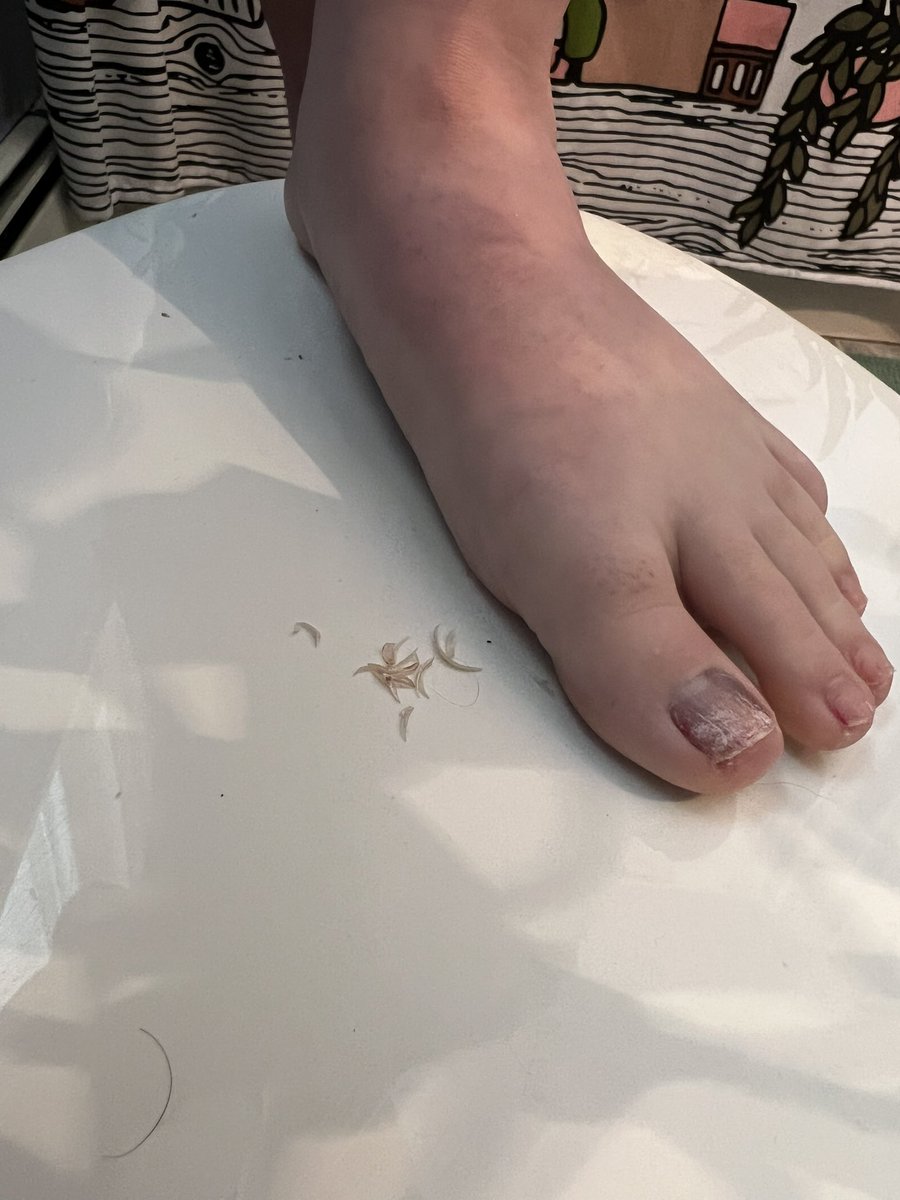 milehigh_toes's tweet photo. bagging up these toe nail clippings for a client ๐ then itโs time to get these little piggies post-race pampered #toenails #feet #runnerfeet #feetpicsforsale https://t.co/yCs00L1fPC