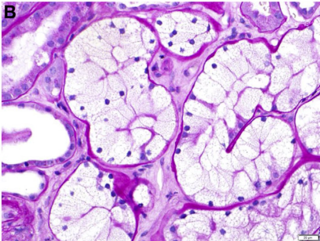 🫘😳Acute kidney injury by SGLT2 inhibitors

➡️Osmotic Nephrosis 

<a href="/AJKDonline/">AJKD</a> 

ajkd.org/action/showPdf…