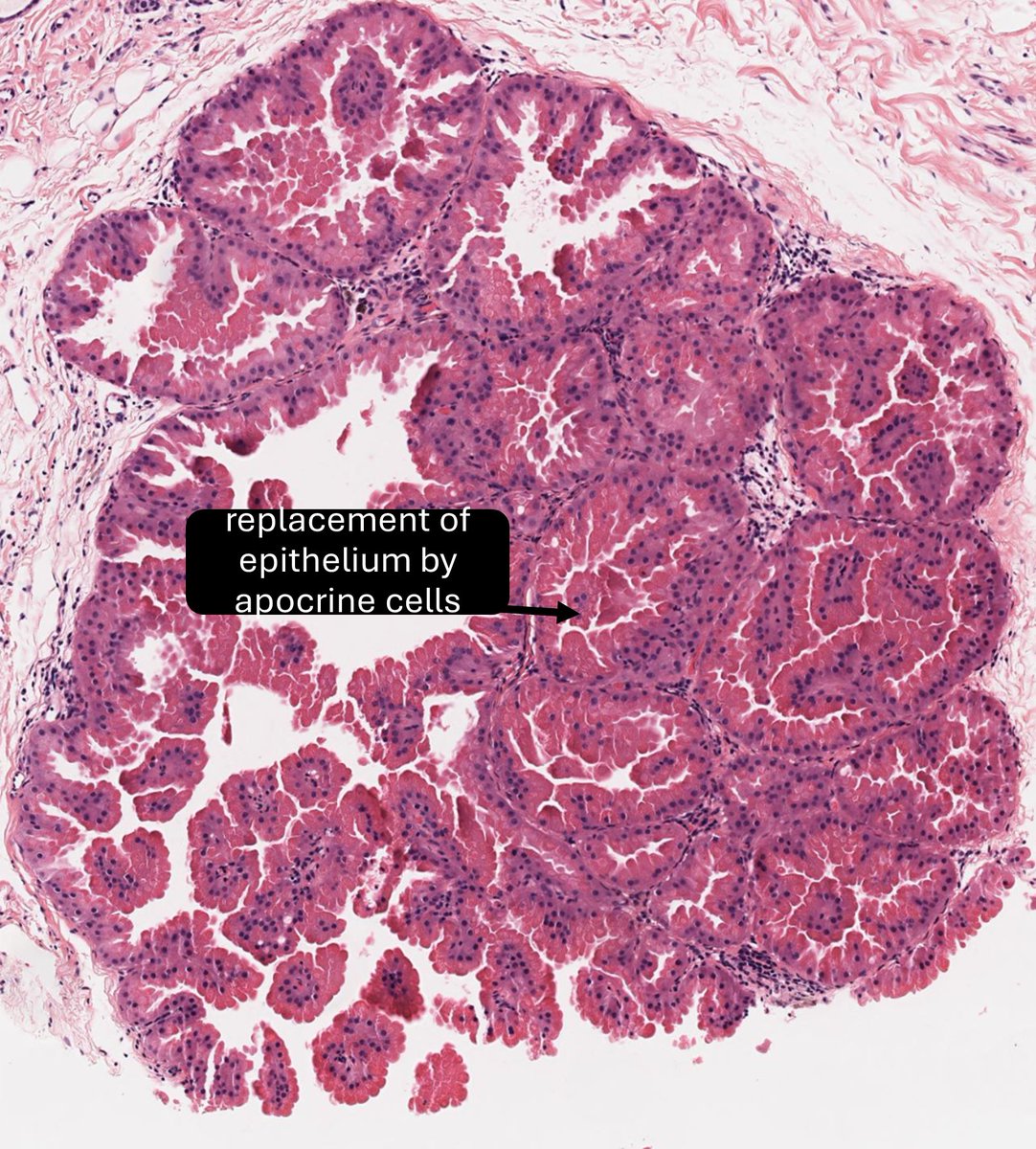 Fibrocystic change (including apocrine metaplasia) Apocrine metaplasia ...