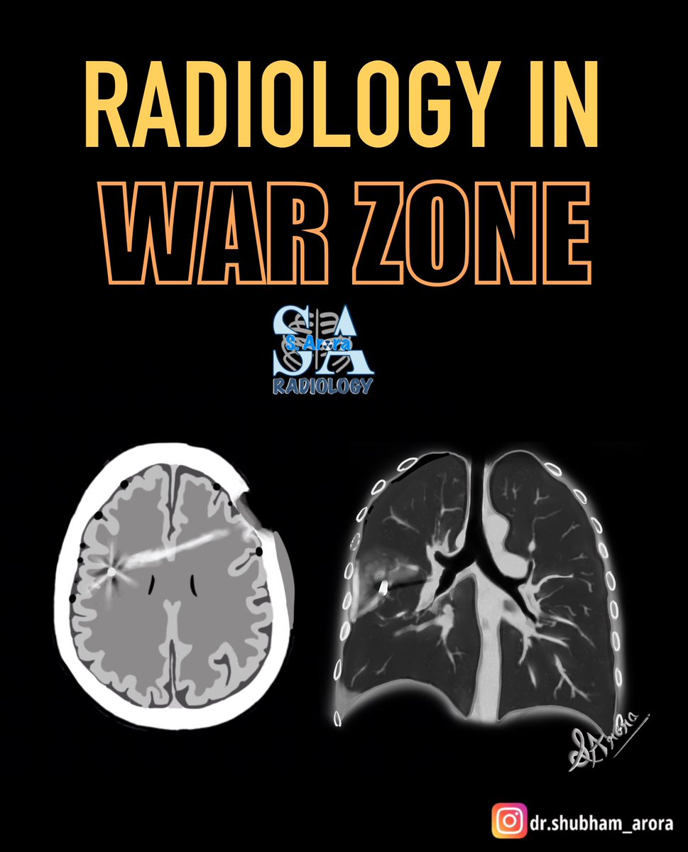 Dr_S_Arora's tweet image. The ongoing conflict underscores the importance of understanding the radiological findings associated with projectile injuries. While we hope for a lasting ceasefire, it remains crucial to be prepared—ideally with knowledge we never need to use.
#radiology #IndiaPakistanConflict
