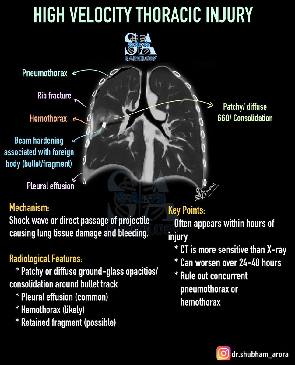Dr_S_Arora's tweet image. The ongoing conflict underscores the importance of understanding the radiological findings associated with projectile injuries. While we hope for a lasting ceasefire, it remains crucial to be prepared—ideally with knowledge we never need to use.
#radiology #IndiaPakistanConflict