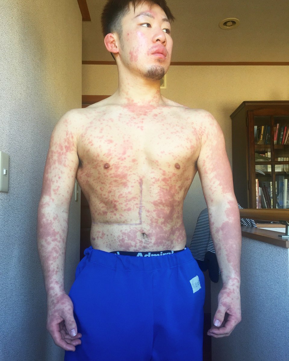 全部、同じ体重です。

・ステージ4の肝臓がん
・手術でお腹に大きな十字の傷
・抗がん剤で全身に発疹
↓
そこから、
もう一度鍛え直して、プロ格闘家としてリングに戻ってきました。

そんな俺の試合、無料で観れます。
応援してくれたら嬉しいです

URL↓