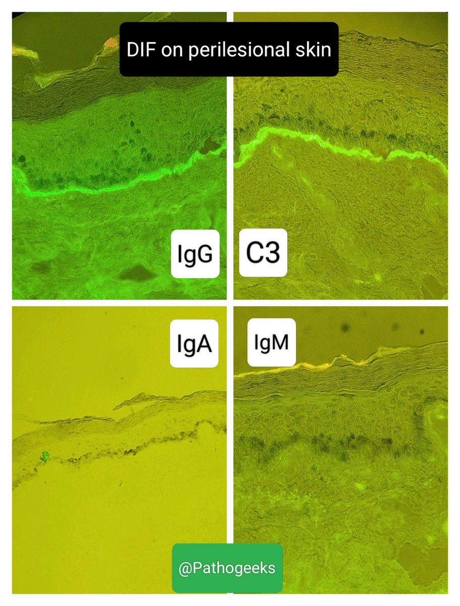 Pathogeeks's tweet photo. 62 y, F with tense bullae all over body since 4 days.
Histopathology 🔬and immunofluorescence 🟢 👀
Diagnosis? 
🌟Imp IBQ for all entrance exams. 
#dermatopath #pathx #pathtwitter #immunofluoresence https://t.co/Bu3l7xIQe0