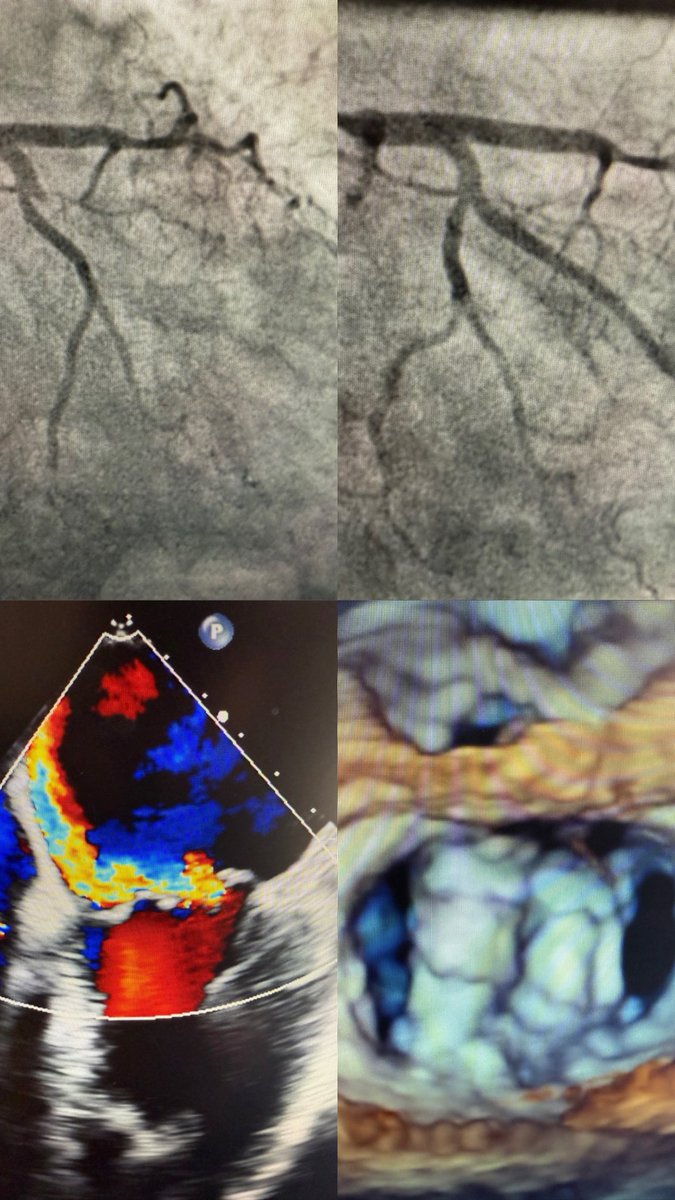 Ahmad Jabri MD , FACC, FSCAI (@ahmadjabri8) on Twitter photo Closing the week! Elderly non-surgical candidate presenting with posterior AMI, cardiogenic shock, and severe mitral regurgitation due to papillary muscle rupture.
PCI + TEER in one go!
<a href="/amrabbasmd/">Amr Abbas</a> <a href="/rohitvyas90/">Rohit Vyas</a> <a href="/IvanHansonMD/">Ivan Hanson</a> <a href="/BrianRenard1/">Brian Renard</a> <a href="/PedroMDMSc/">Pedro Villablanca MD, MSc, FACC, FSCAI</a> <a href="/g_giustinoMD/">Gennaro Giustino, MD</a> Closing the week! Elderly non-surgical candidate presenting with posterior AMI, cardiogenic shock, and severe mitral regurgitation due to papillary muscle rupture.
PCI + TEER in one go!
<a href="/amrabbasmd/">Amr Abbas</a> <a href="/rohitvyas90/">Rohit Vyas</a> <a href="/IvanHansonMD/">Ivan Hanson</a> <a href="/BrianRenard1/">Brian Renard</a> <a href="/PedroMDMSc/">Pedro Villablanca MD, MSc, FACC, FSCAI</a> <a href="/g_giustinoMD/">Gennaro Giustino, MD</a>