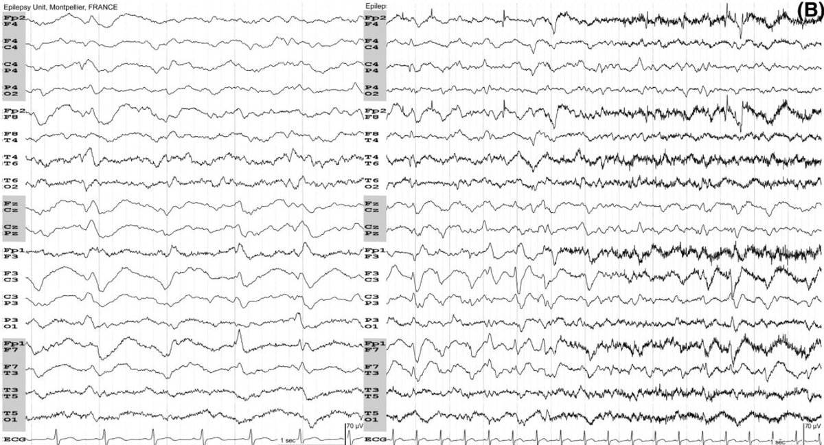 phi3417's tweet image. Asymmetric triphasic waves. This asymmetry is in relation to a postoperative breach rhythm. TWs disappeared when the level of consciousness increased. This reactivity clearly differentiates it from nonconvulsive status epilepticus.doi.org/10.1111/epi.17…